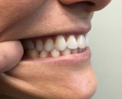 Teeth from the side