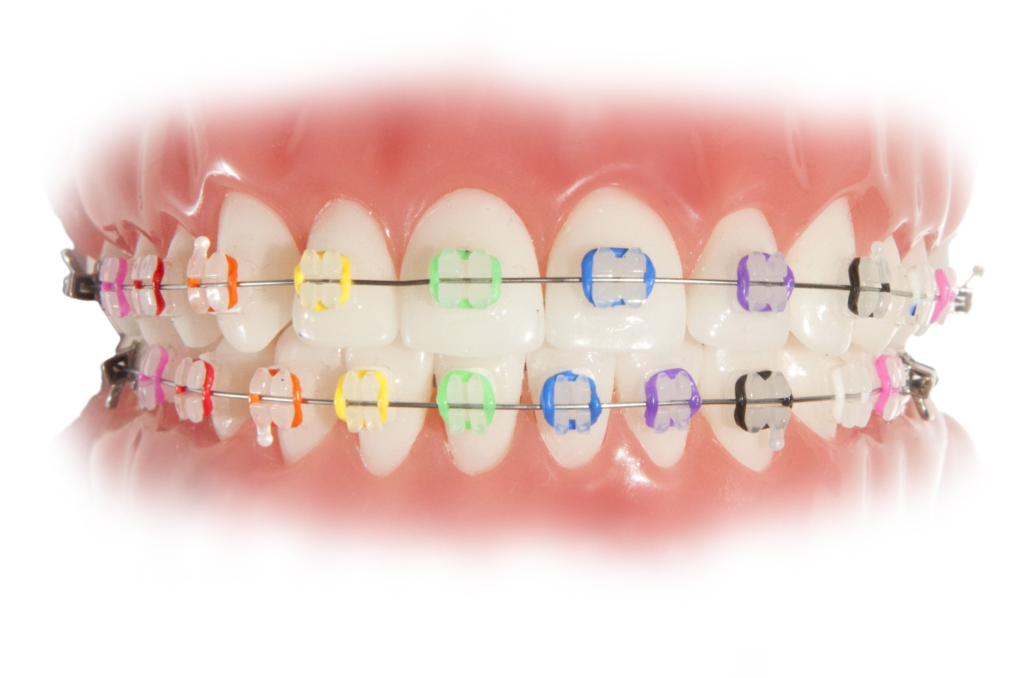 Clear braces with colorful rubber bands