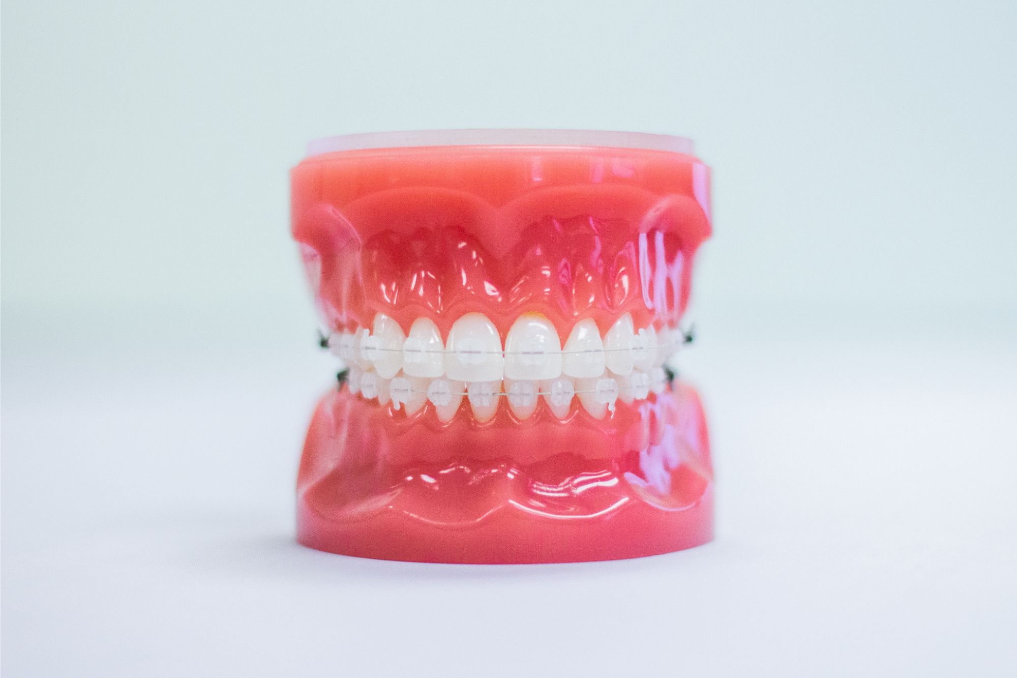 Clear ceramic braces on a dental model, blending in with the natural color of the teeth