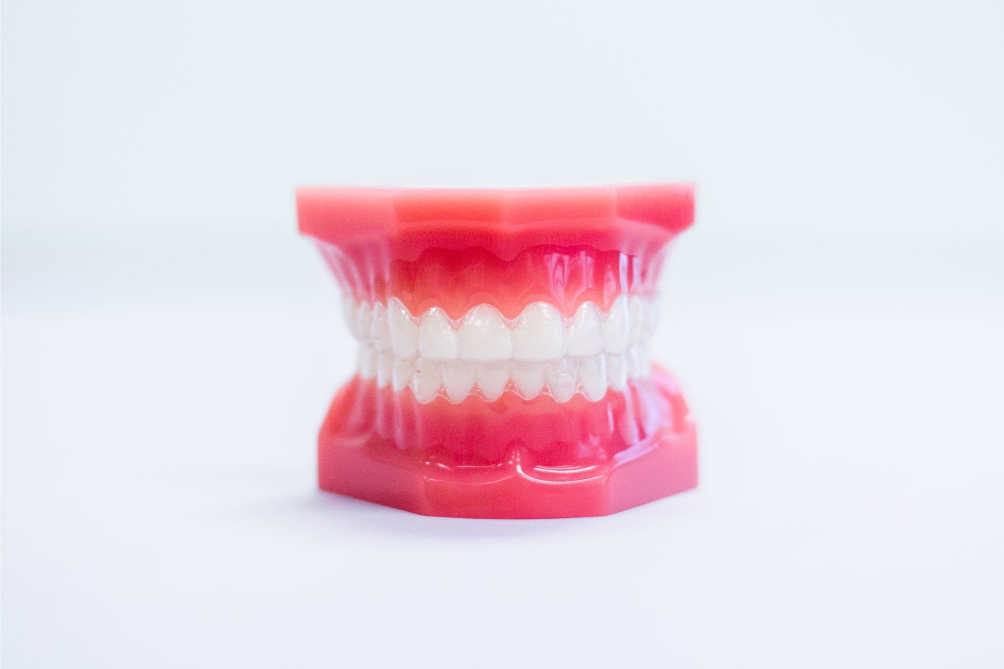 Removable Invisalign clear aligner tray placed over a dental model of the teeth