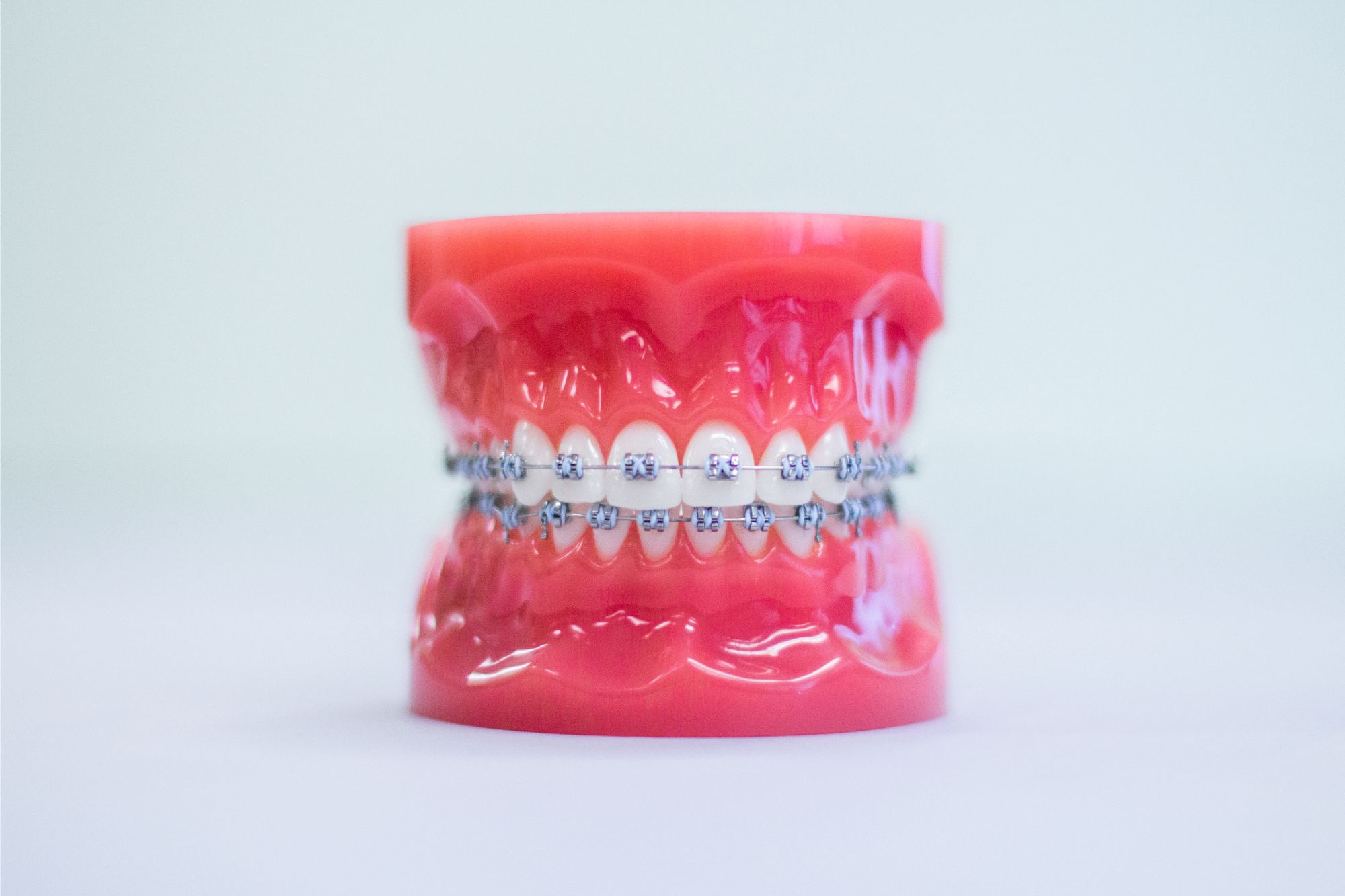 Traditional metal braces fitted on a dental model of the upper and lower teeth